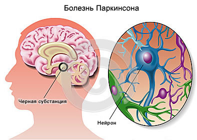 Хвороба Паркінсона, симптоми хвороби, методи лікування