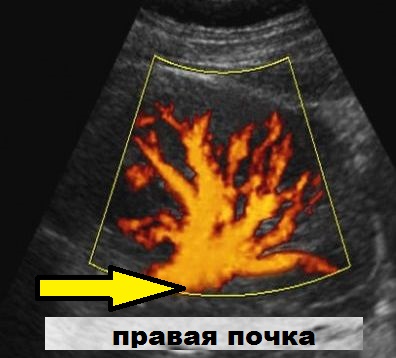 УЗИ в Полтаве - ультразвуковое исследование почек - правая почка