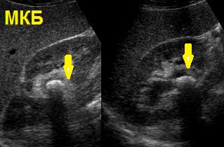 УЗД у Полтаві, ультразвукове дослідження нирок
