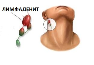 УЗИ  в Полтаве - лимфаденит