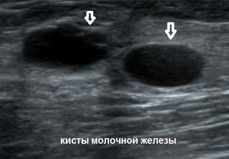 УЗД у Полтаві - кісти молочної залози