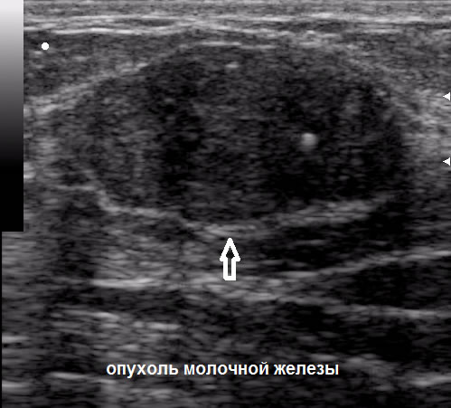 Ультразвуковое Исследование Молочной Железы Скачать
