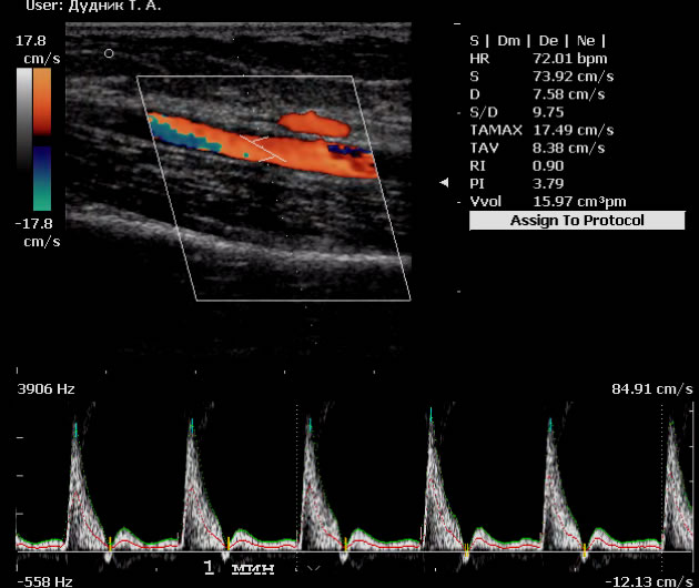 УЗИ в Полтаве  сосудов шеи и сосудов головы