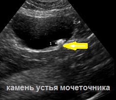 Ультразвуковое исследование предстательной железы, мочевого пузыря