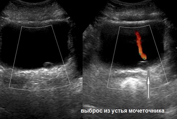 Ультразвуковое исследование предстательной железы, мочевого пузыря