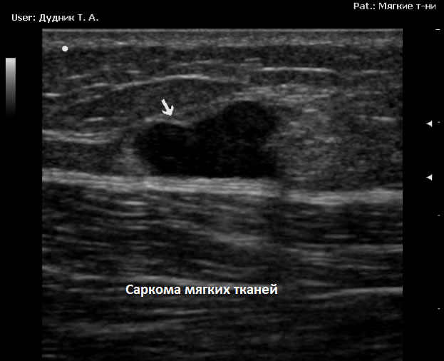 УЗИ в Полтаве - саркома мягких тканей