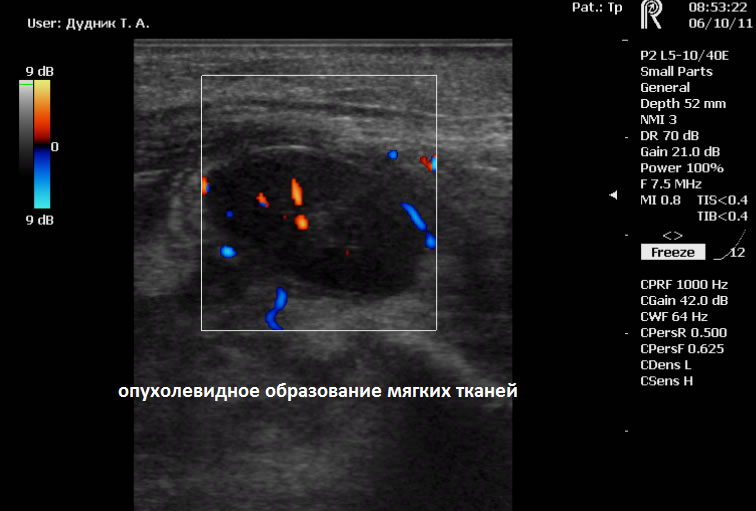 УЗИ в Полтаве - опухолевидное образование мягких тканей