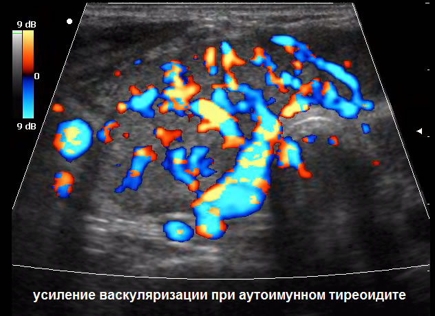 УЗИ в Полтаве - ультразвуковое исследование щитовидной железы: усиление васкуляризации при аутоимунном тиреоидите