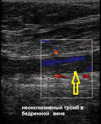 УЗИ в Полтаве - неоклюзивный тромб в бедренной вене