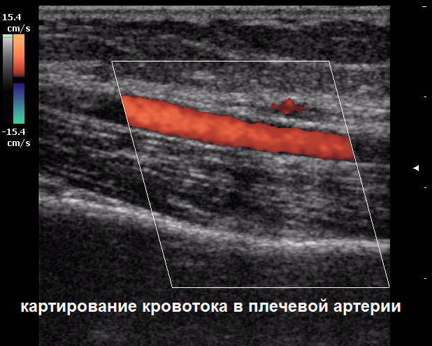 УЗИ в Полтаве - картирование кровотока в плечевой артерии
