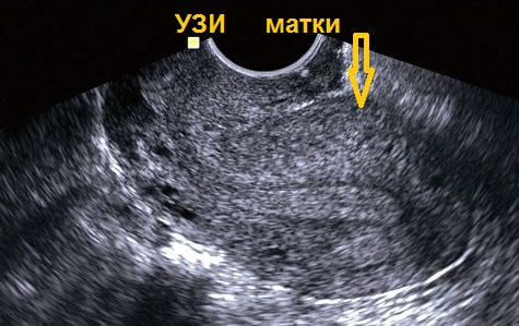 УЗИ в Полтаве матки