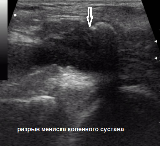 УЗИ в Полтаве - ультразвуковое исследование суставов: разрыв мениска коленного сустава