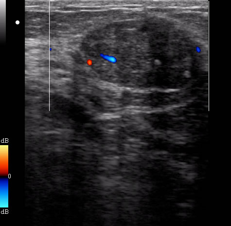 УЗД у Полтаві - ультразвукове дослідження молочних залоз (ультразвукова мамографія)