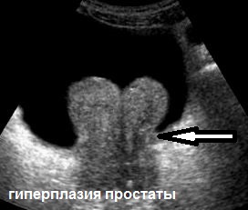 УЗИ в Полтаве - ультразвуковое исследование предстательной железы, мочевого пузыря