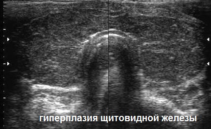 УЗИ в Полтаве - гиперплазия щитовидной железы