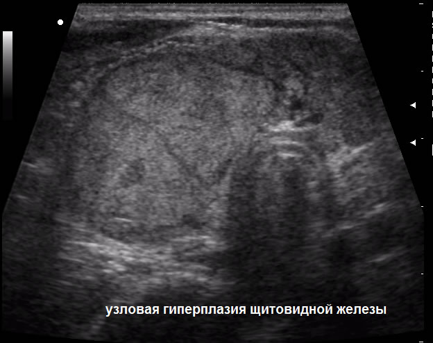 УЗД у Полтаві - вузлова гіперплазія щитовидної залози
